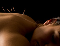 Acupuncture Newcastle