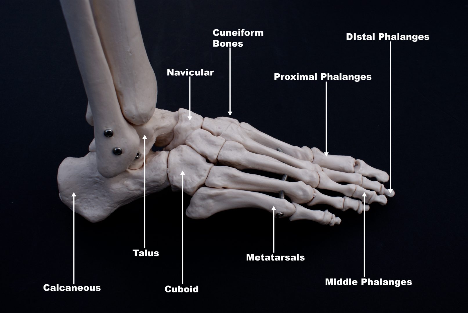 fifth metatarsal fracture treatment and tips
